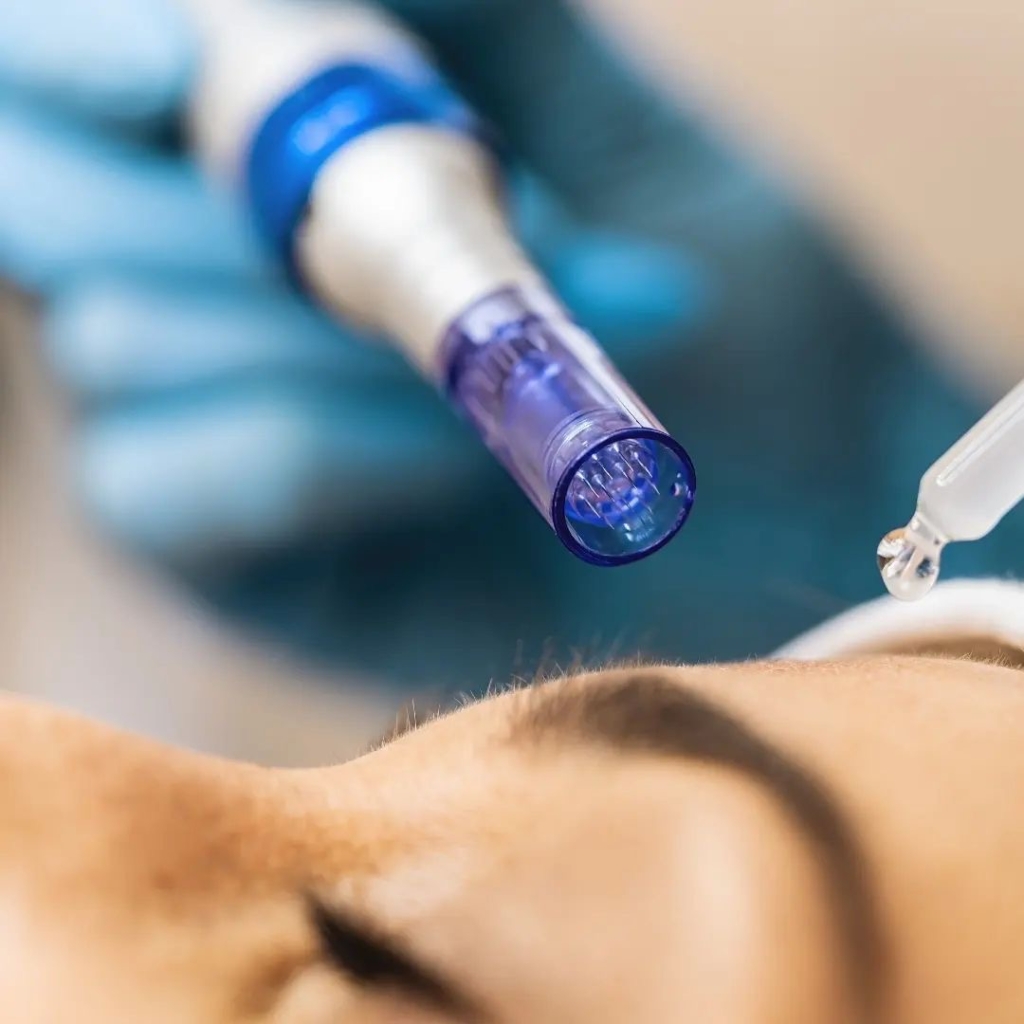 Dermapen Microneedling